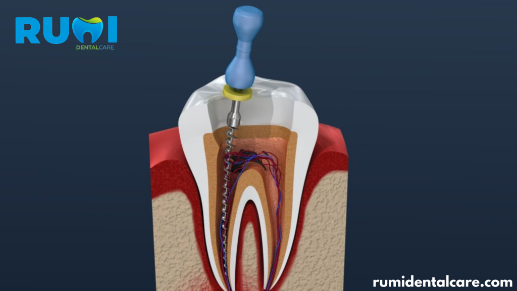 Dental root canal treatment procedure / ڈینٹل روٹ کینال علاج کا طریقہ کار
