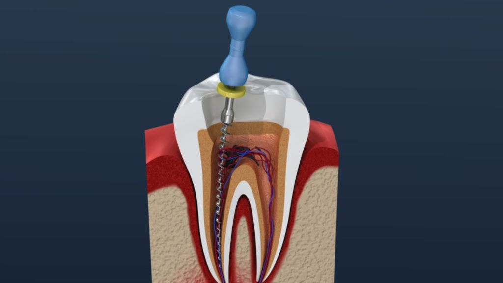Dental root canal treatment procedure illustration